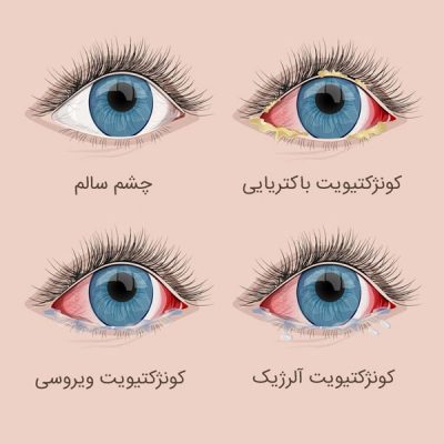كونژنكتيويت يا التهاب ملتحمه كونژنكتيويت يا التهاب ملتحمه