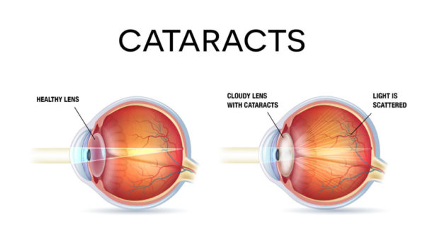 cataracte کاتاراکت - آب مروارید