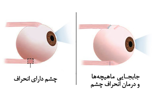 strabismus انحراف چشم استرابیسم