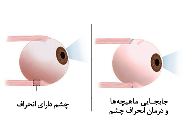 strabismus انحراف چشم استرابیسم