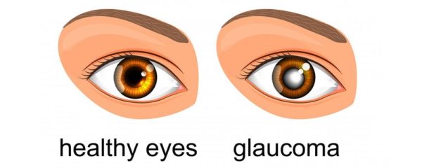 آب سیاه - گلوکوم - glaucoma