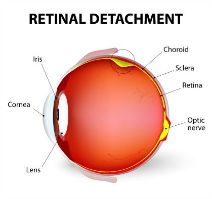 Retina surgery