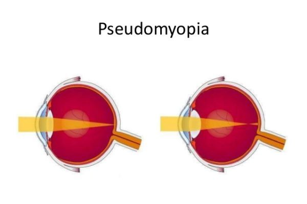 pseudomyopia - نزدیک بینی کاذب - دکتر افتخاری