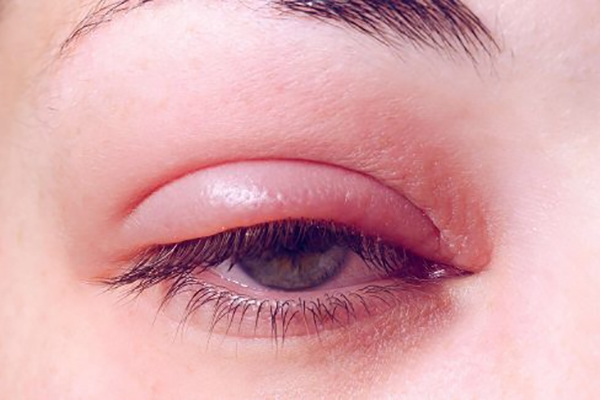 بلفاریت blepharitis