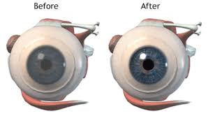 عمل پیوند قرنیه