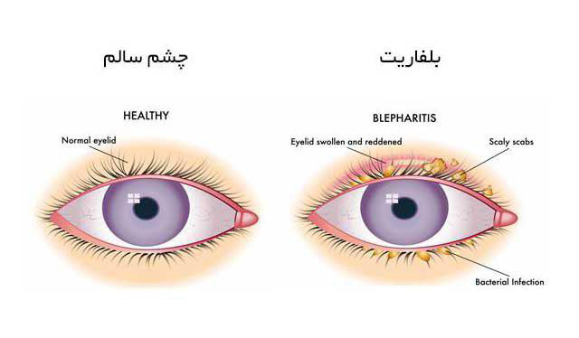 بلفاریت blepharitis