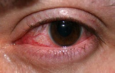 مراقب عفونت‌های ویروسی چشم باشید